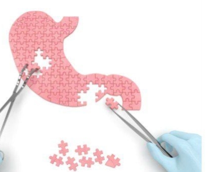 Ung thư dạ dày tái phát sau phẫu thuật triệt căn phải làm sao